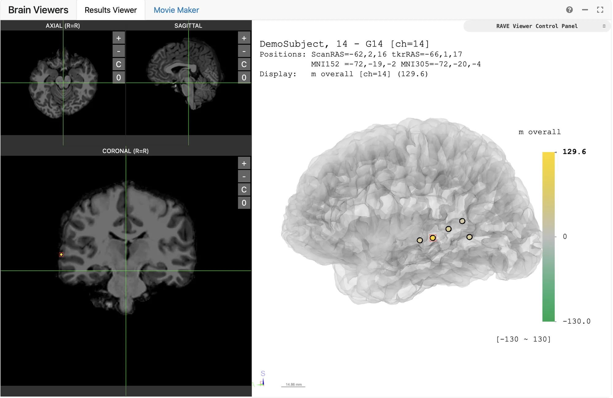 The 3D viewer with a see-through brain, green-to-yellow electrode colors and a large coronal slice